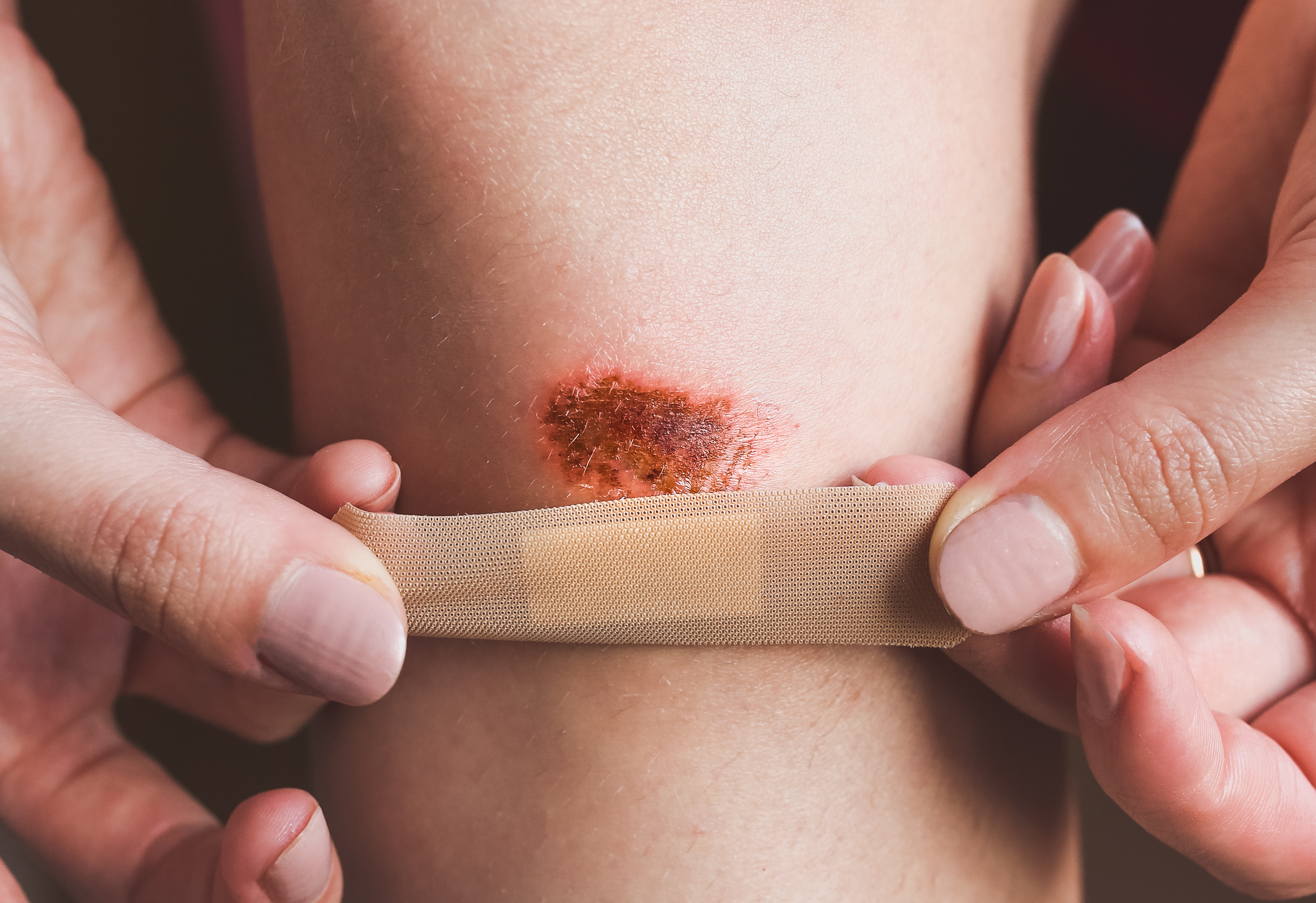 band-aid on a skinned knee